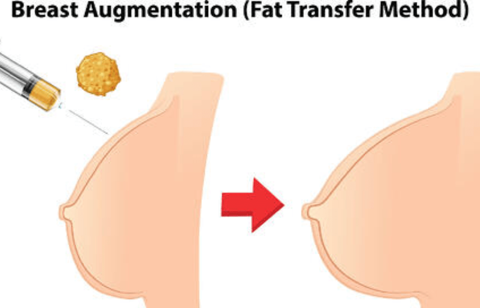 breast fat grafting in indore, breast surgery in indore